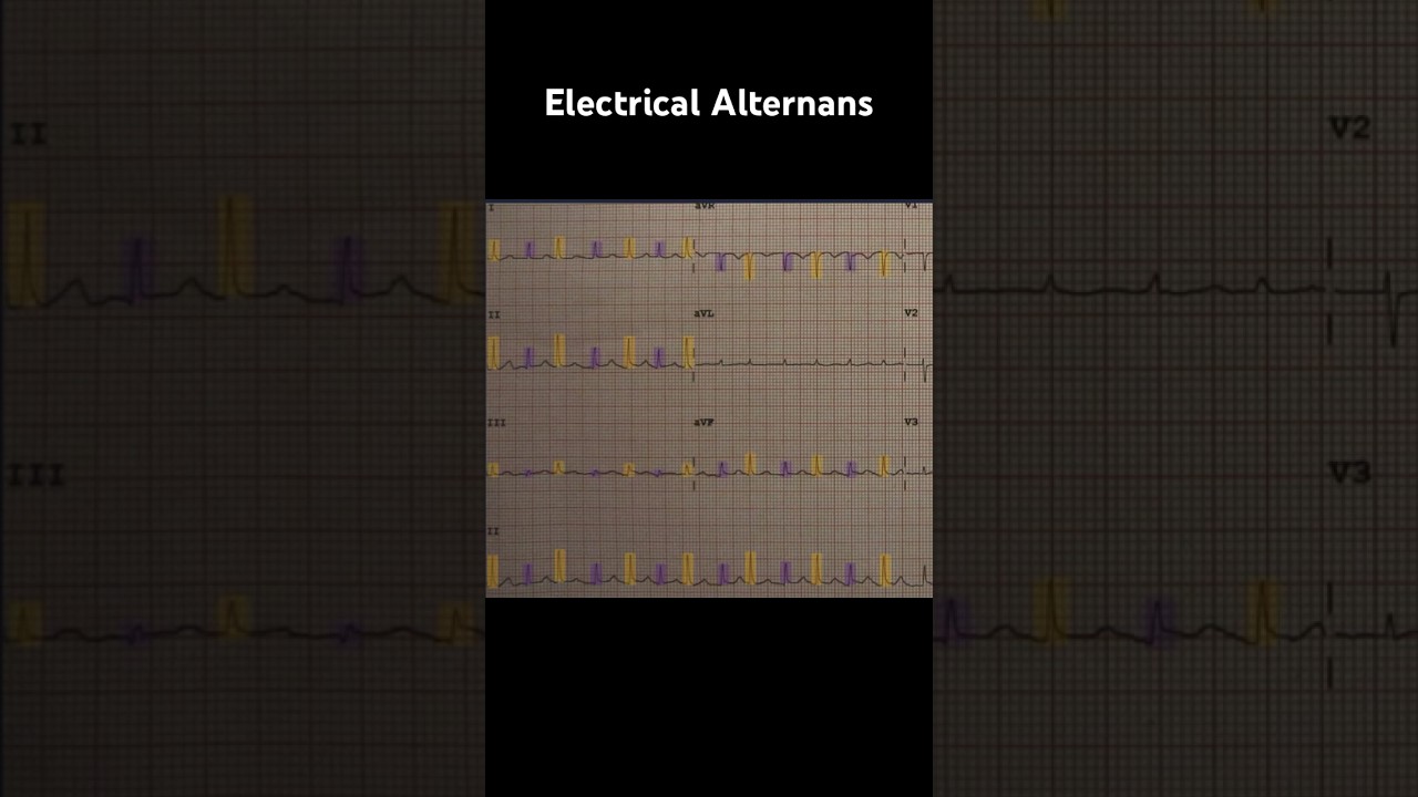 Electrical Alternans ECG: Example 2