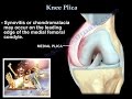 Knee Plica  and  Knee pain - Everything You Need To Know - Dr. Nabil Ebraheim