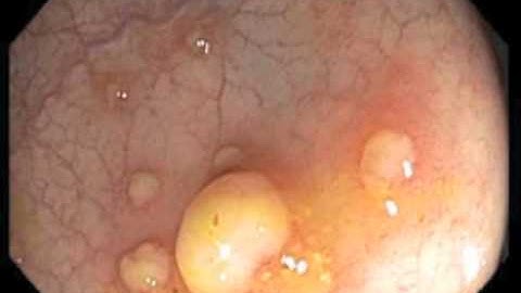 Colonoscopy Channel - Pseudomembranous colitis