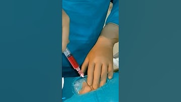 Varicocele embolization live case - Step 1 | Dr. Gaurav Gangwani
