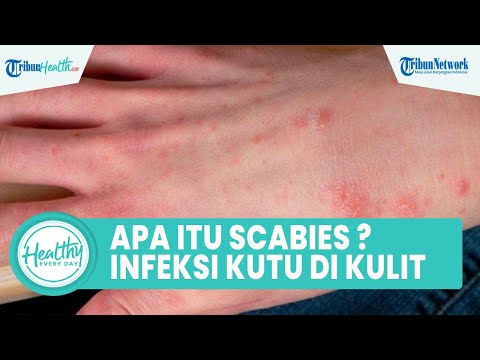 Apa itu Scabies? Faktor Risiko dan Cara Atasi Infeksi Kutu pada Kulit