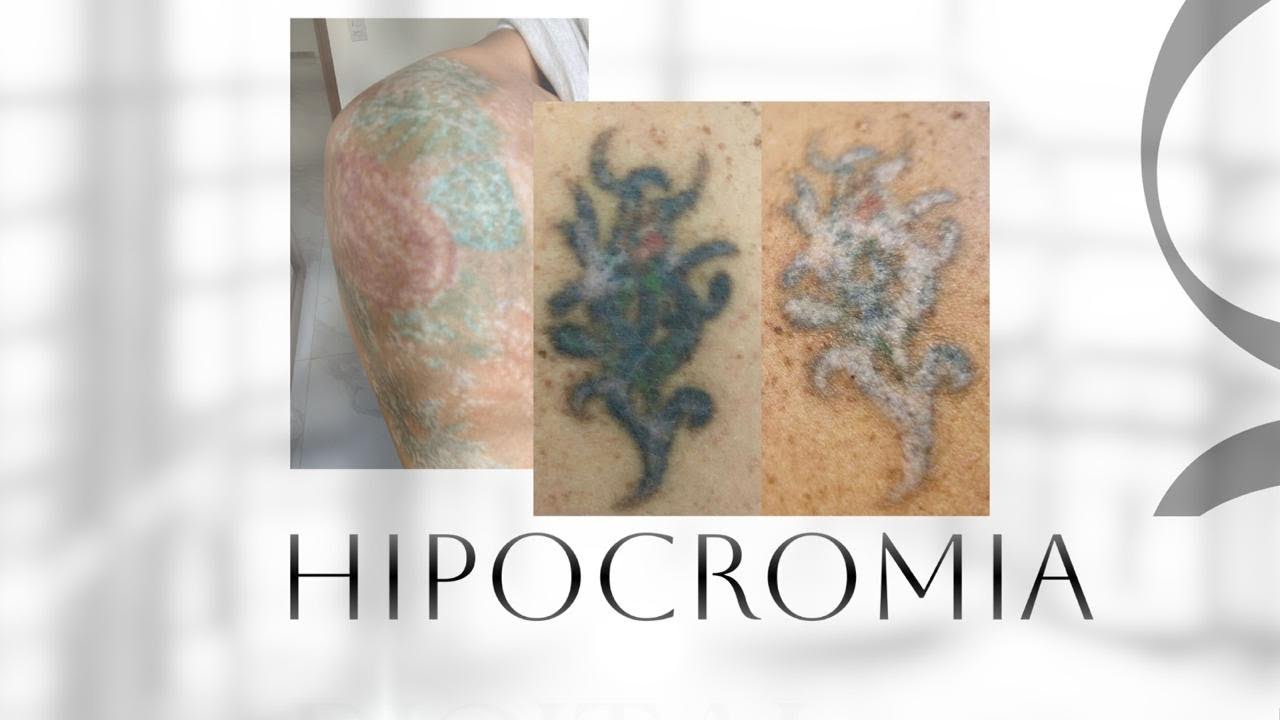 HIPOCROMIA- Intercorrência na Remoção de tatuagem