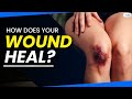 Understanding Wound Healing