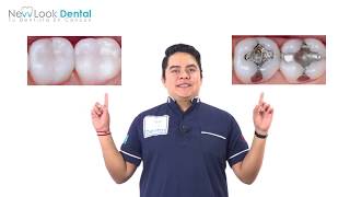 ¿Amalgamas VS resinas? 💯🦷 | Resinas Dentales: Más Allá de la Estética, una Elección Saludable