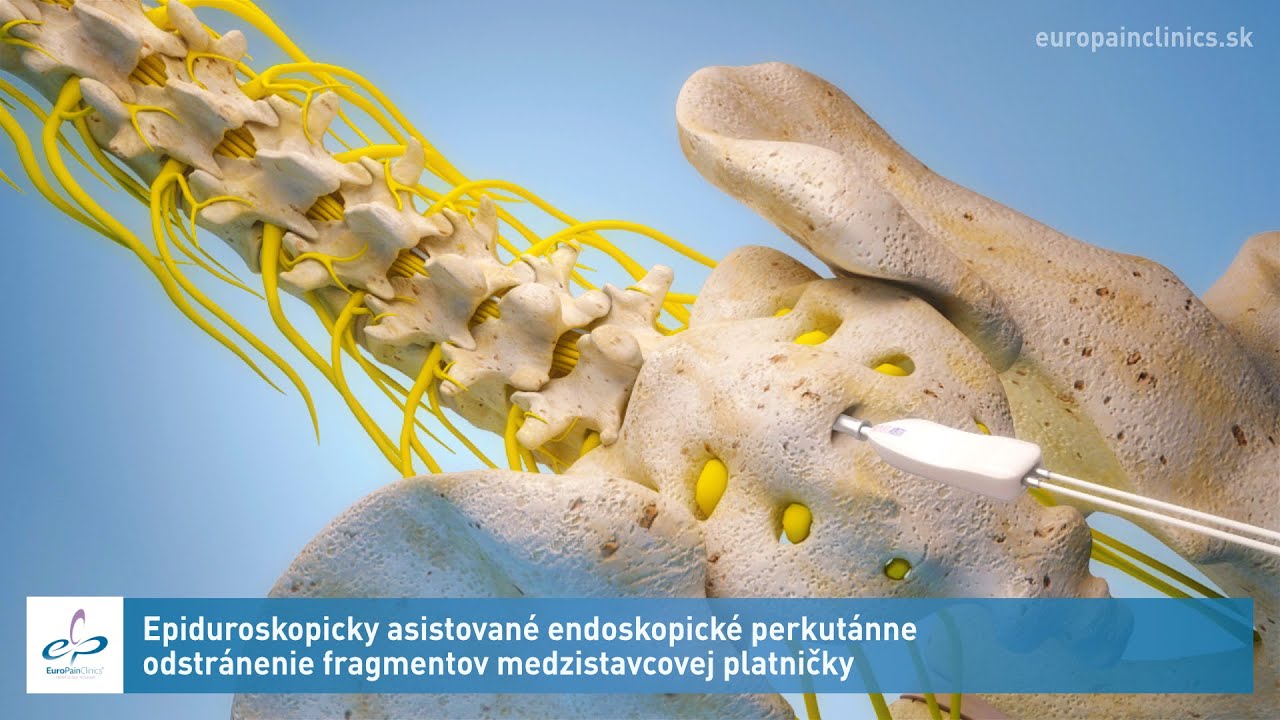 Epiduroskopicky asistované endoskopické perkutánne odstránenie fragmentov medzistavcovej platničky