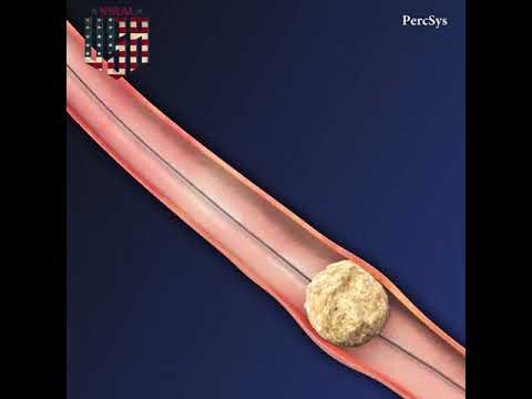 CoAx 10mm Stone Control Catheter by Accordion Medical