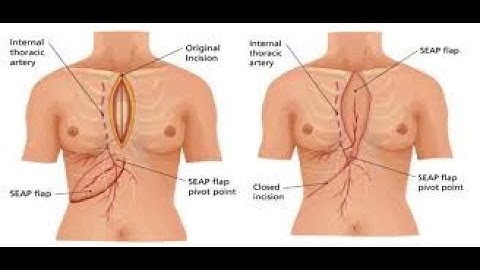 Sternal debridement  CPT code - simplify medical coding