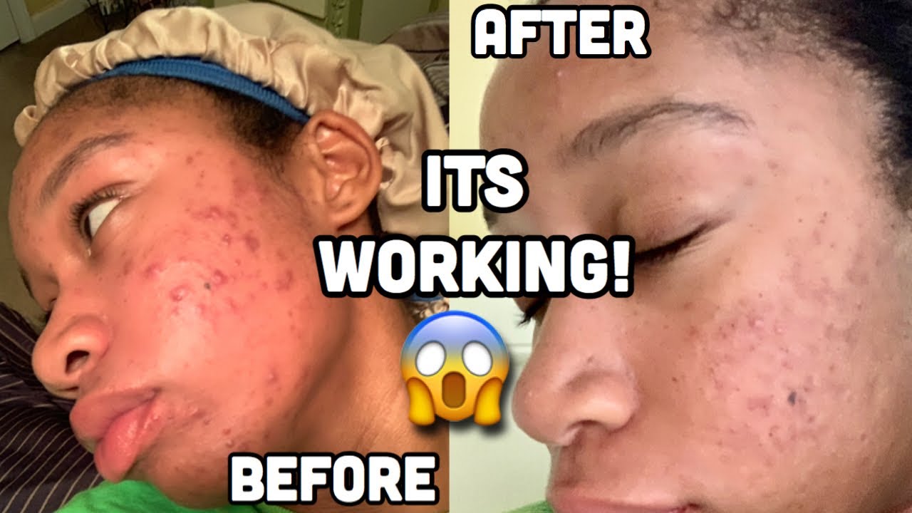 1 MONTH ACCUTANE UPDATE IM EXPERIENCING JOINT PAIN Mariah Perry
