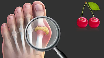 Is Salt OK for gout?