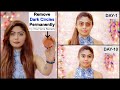 Remove DARK CIRCLES  Permanently In 10 Days- Home Remedy