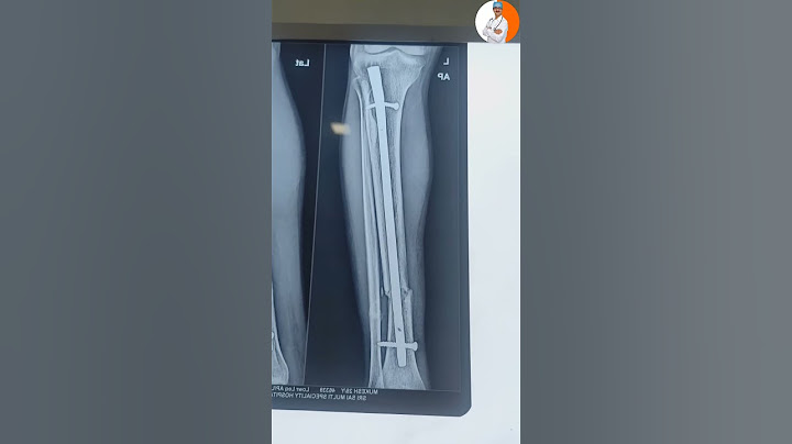 What will happen if the screw of the plate breaks during bone operation?