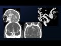 Clipping of ruptured dolichoectatic aca aneurysm in poorgrade patient with subarachnoid hemorrhage