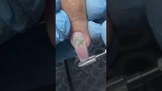 Nail Fungus? #nailfungustreatment #fungus #hongosenlasuñas #nails #nailtreatment #nailtutorial