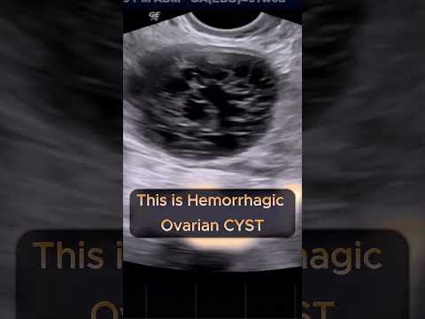 Hemorrhagic Ovarian Cyst