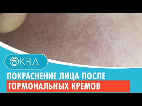 👉 Покраснение лица после гормональных кремов. Клинический случай №536