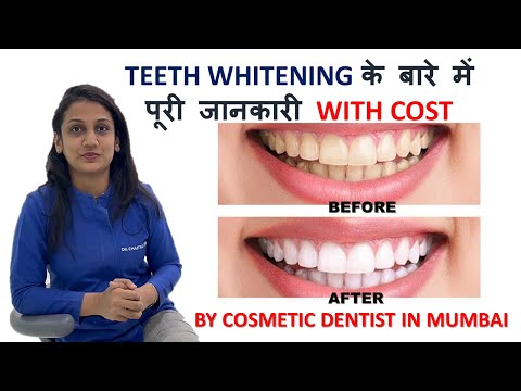 Teeth Whitening के बारे में पूरी जानकारी With Cost - By Cosmetic Dentist In Mumbai