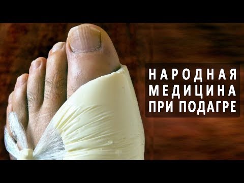 Народная медицина в лечении подагры