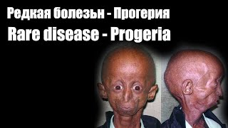Редкая болезнь - Прогерия | История о пугающей болезни | Страшное неизлечимое заболевание.
