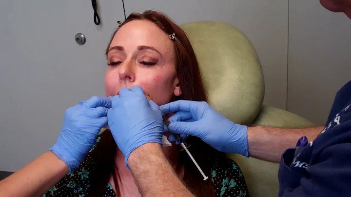 PRFM Advanced PRP for facial rejuvenation with Dr ...