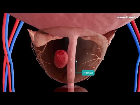 Video: Ist die Prostatektomie eine große Operation?