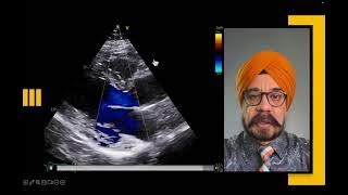 The Aortic Regurgitation Illusion: From Mild-Moderate to Truly Severe