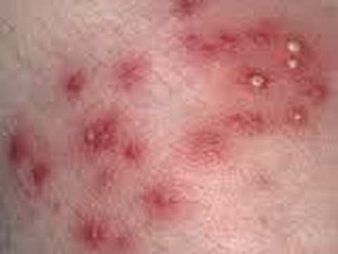stop folliculitis at home 3 simple steps youtube