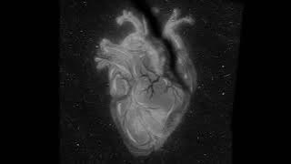 My very irregular heartbeat under pressure #3