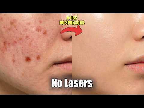 How I Faded My Acne Scars & Dark Spots — No Lasers, No Derma (Korean Skincare routine)