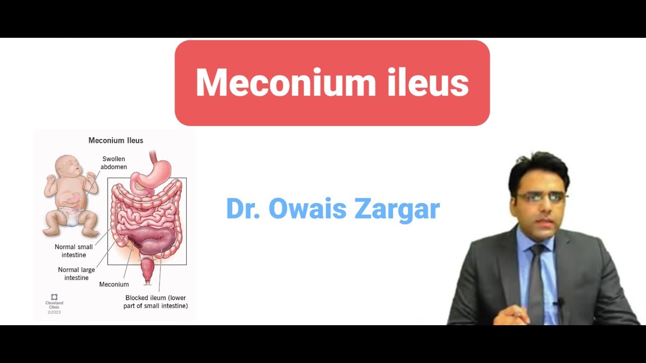 Topic MECONIUM ILEUS Surgery Simplified by Dr.Owais Zargar YouTube