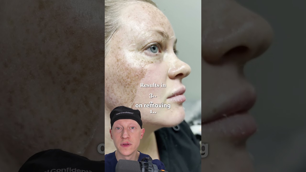 POV: You found out your freckles are actually SUN DAMAGE