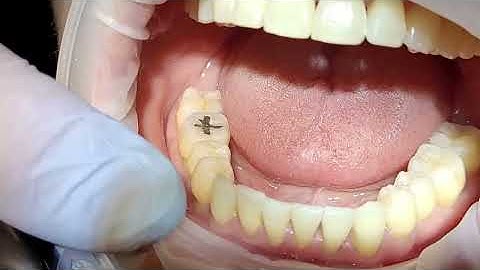 How to do IPR with Invisalign?