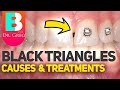 Tooth Gaps / Black Triangles with Braces or Invisalign