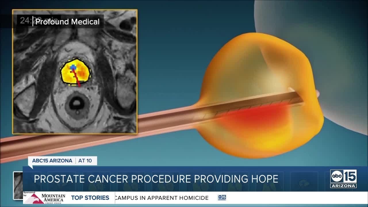 A new treatment option for men battling prostate cancer - YouTube