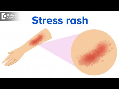 What is a stress rash? - Dr. Rajdeep Mysore