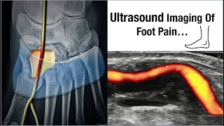 Going Deep: A Fascinating Peek into Nerve Entrapment in the Foot I MSK Ultrasound I Dr. Ankit Shah screenshot 3