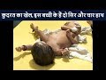 कुदरत का खेल, इस बच्ची के हैं दो सिर और चार हाथ | News18 Hindi