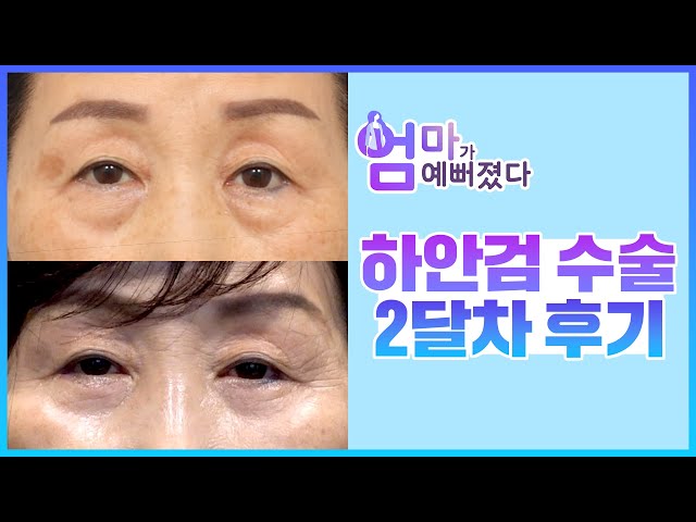 성형외과 의사 아들이 직접 하안검수술한 어머님 2달 차 후기