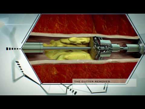 Dahir Insaat: Cholesterol Deposit Removal