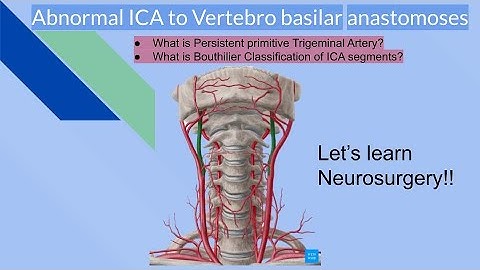 Persistent Primitive trigeminal Artery (PPTA), ICA-VB anastomoses. Bouthilier classification of ICA