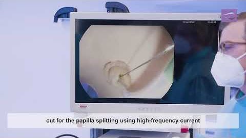 ERCP procedure using a  Triple lumen  Standard  Sphincterotome by Endo-Flex