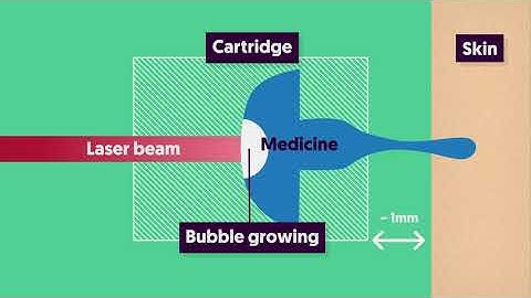 Explanation of laser-induced cavitation and jet injection