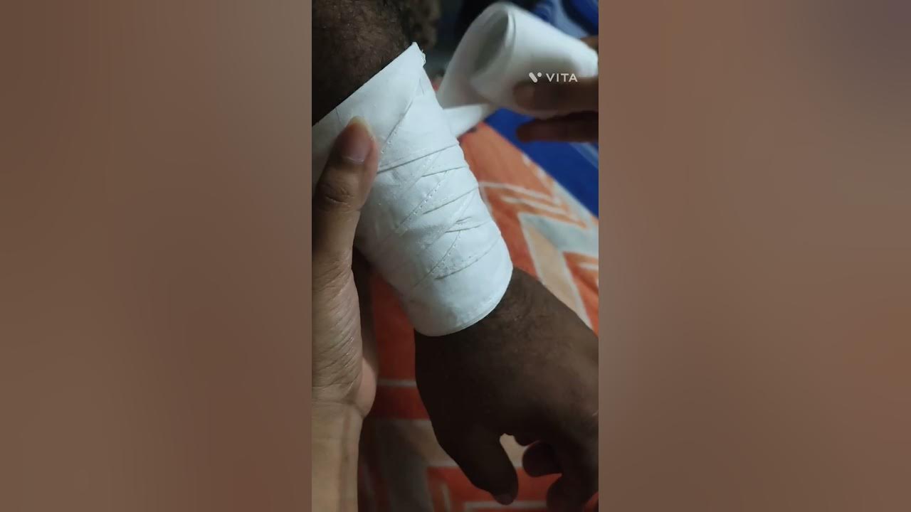 Reverse Spiral Bandaging Technique ( First Aid ) YouTube