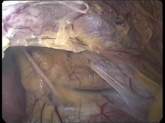 Киста перикарда