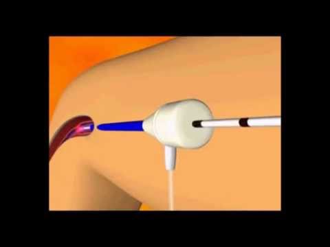 Laser Treatment for Varicose Veins hernia treatment in homeopathy in hindi