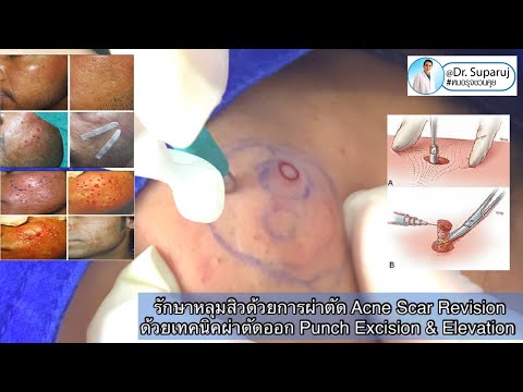 รักษาหลุมสิวด้วยการผ่าตัด Acne Scar Revisionด้วยเทคนิคผ่าตัดออก Punch Excision & Elevation