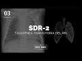 Taquipnea transitoria del recién nacido - ENARM
