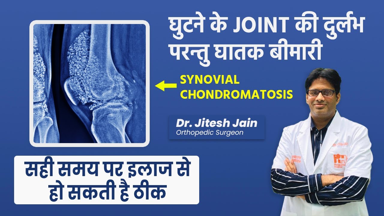 Synovial chondromatosis - Symptoms, Diagnosis, and Treatment (In Hindi) | Dr. Jitesh Jain