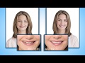 Introduction to the Snap-On Smile® Provisional Appliance image