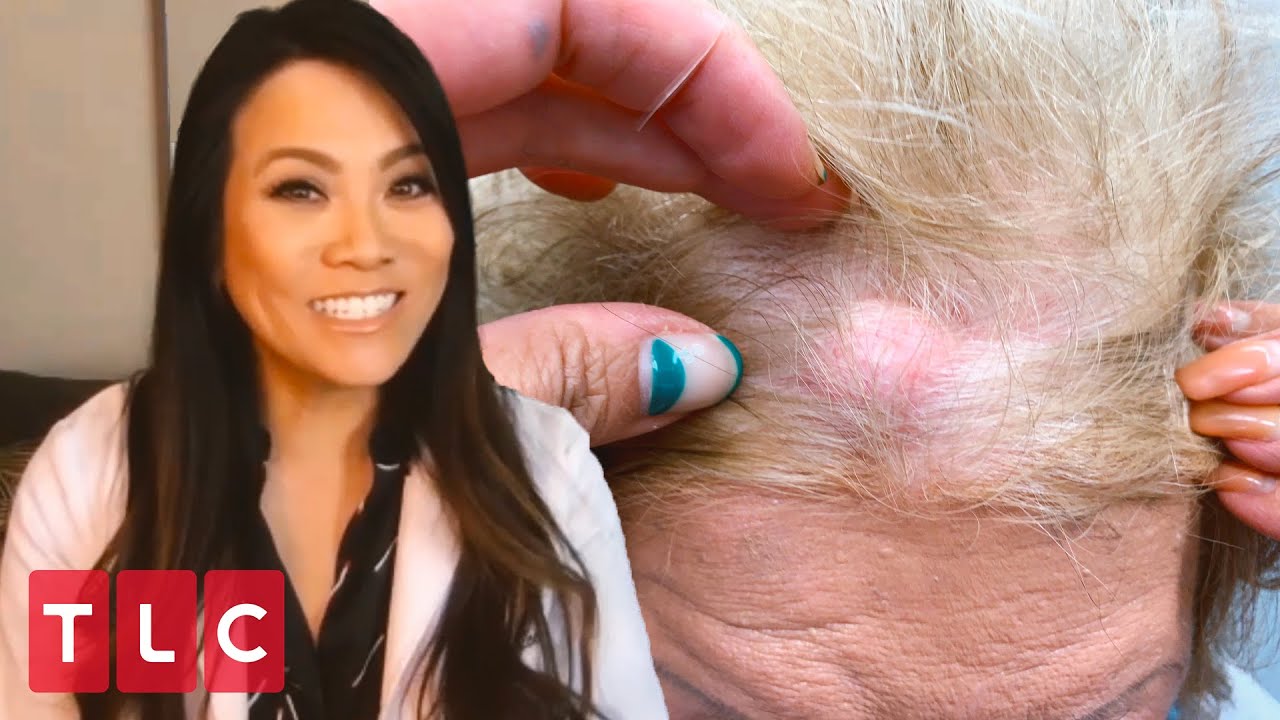 Download Removing a Boston Cherry Cyst! | Dr. Pimple Popper: This is Zit