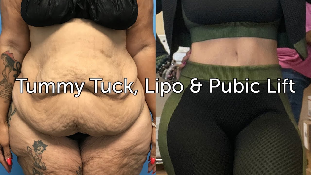 Tummy tuck with liposuction of the mons pubis, and a pubic lift